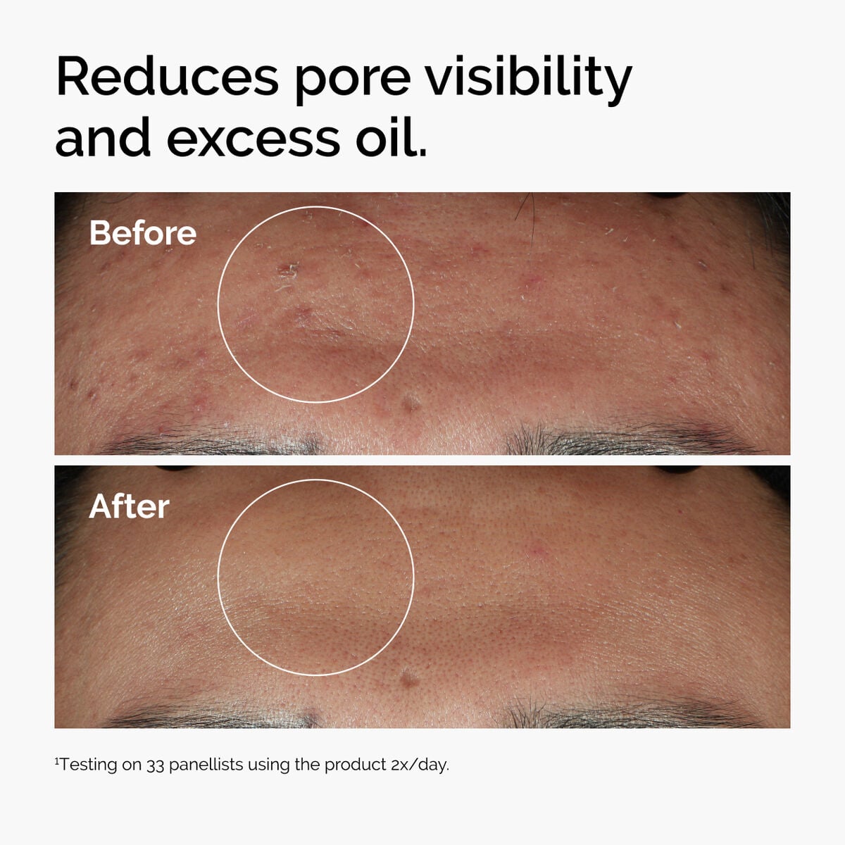 niacinamide-10-zinc-1-c1 ord-niacinamide-zinc-blemish-serum-before-after-pores.jpg