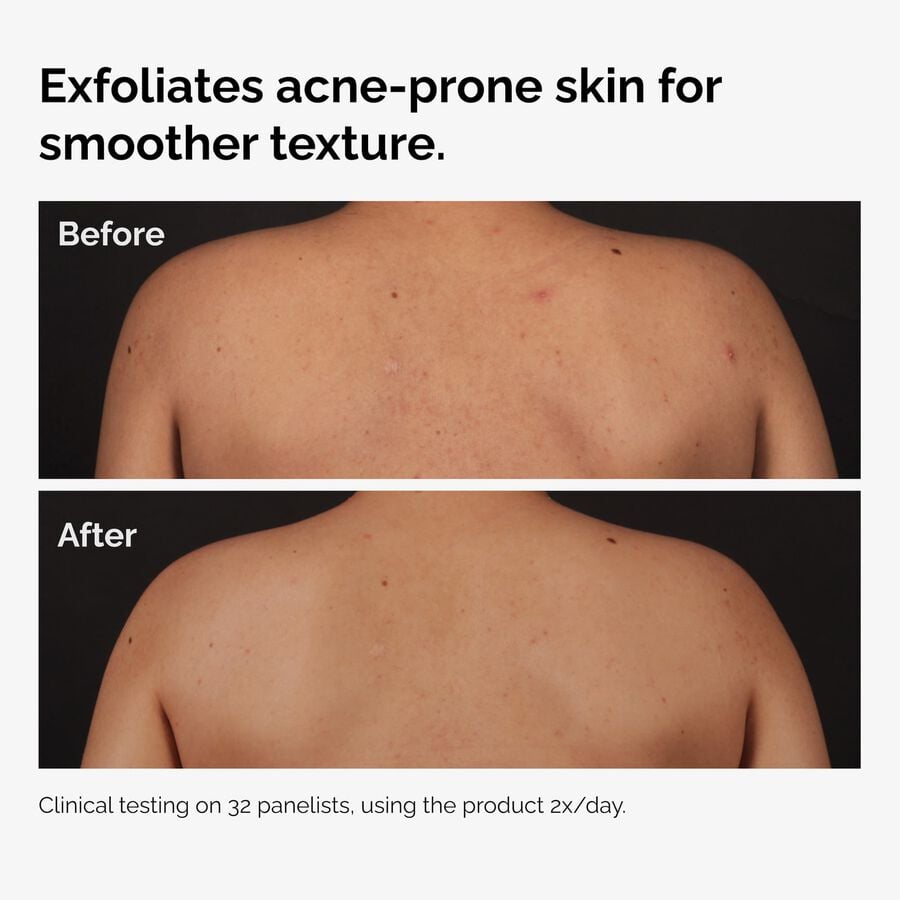 the-body-care-collection-u1 ord-salicylic-acid-body-serum-before-after-graphic-NA.jpg